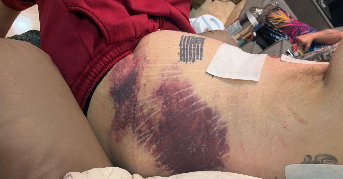 Corey Harrison's bruising on the side of his stomach. 