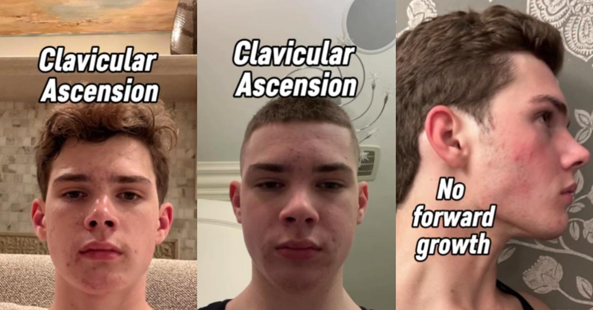 In a video, Clavicular aka Braden Peters shows what his face and jaw looked like before looksmaxxing.
