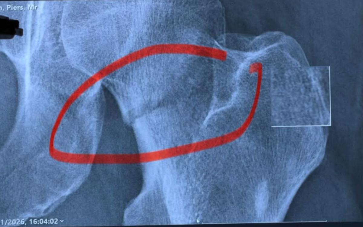 Piers Morgan's x-ray