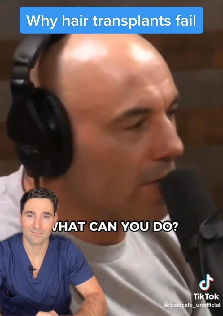 Doctor discusses why hair transplants fail