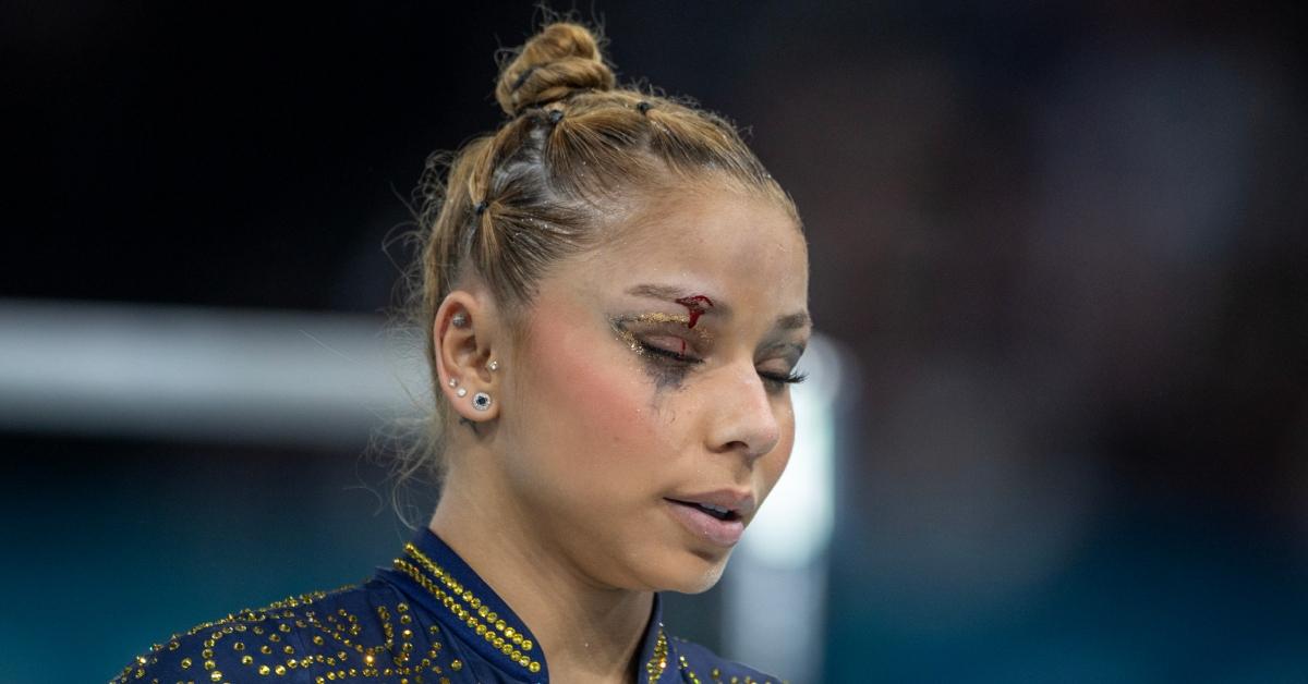 Flavia Saraiva showing her black eye after being injured.