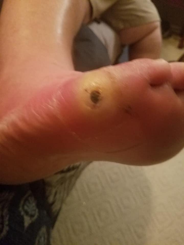 big tee foot infection