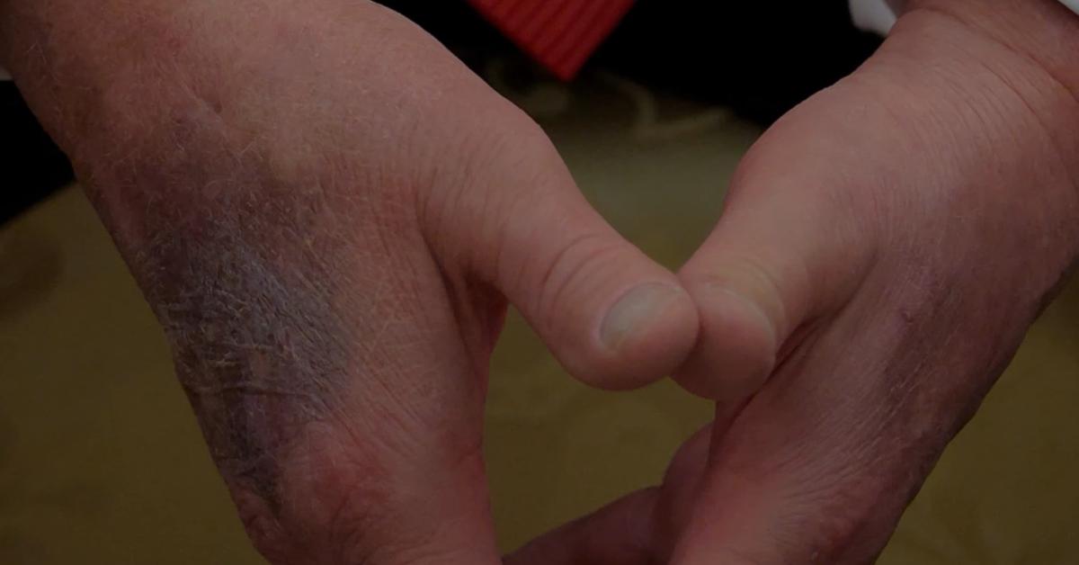 President Donald Trump's hands showed marked bruising in August 2025