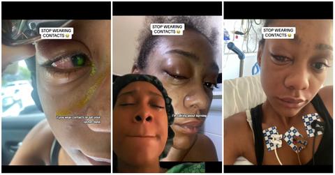 (l-r): A woman on TikTok showing her corneal ulcer