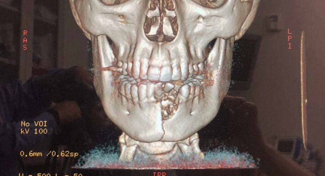 Exploding Mouth Vape Explodes In 14-Year-Old's Mouth, Breaking Jaw and Teeth