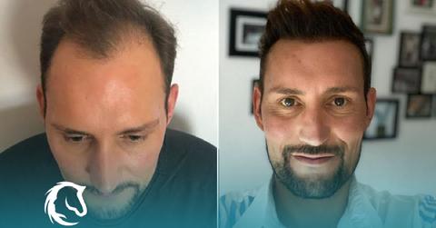 The Top Hair Transplants in Turkey: The 2026 Top 10 Clinic Ranking