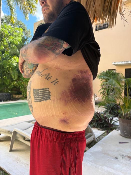 Injuries from Corey Harrison’s accident.